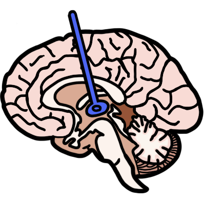 A side-view cross-section of a human brain. The thalamus is highlighted in blue, with a blue line pointing to it.